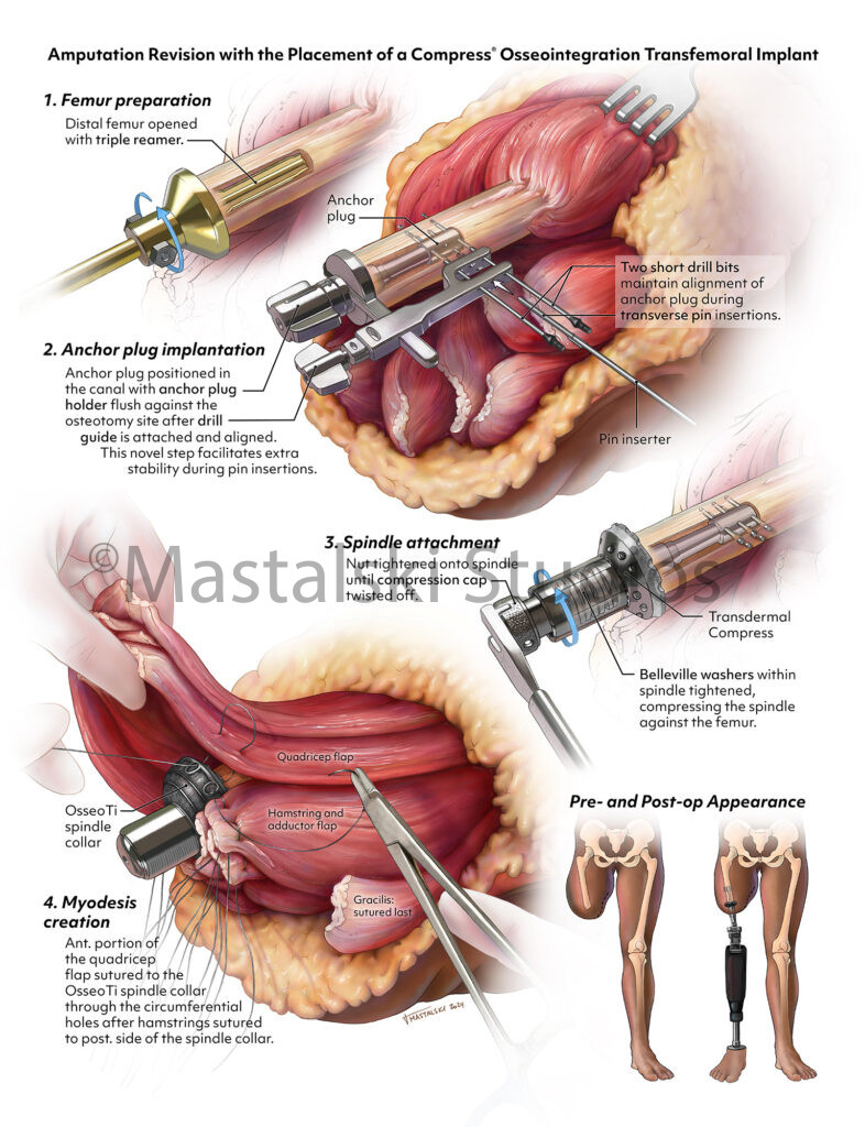 Amputation Revision with the Placement of a Compress Osseointegration Transfemoral Implant