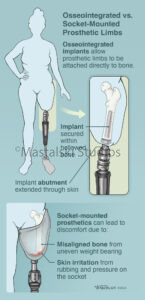 Osseointegrated vs. Socket-Mounted Prosthetic Limbs