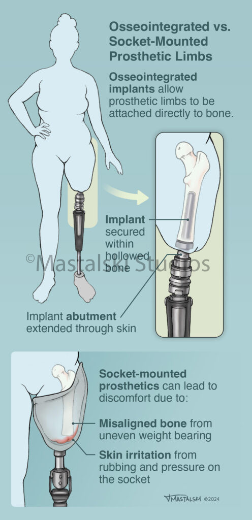 Osseointegrated vs. Socket-Mounted Prosthetic Limbs