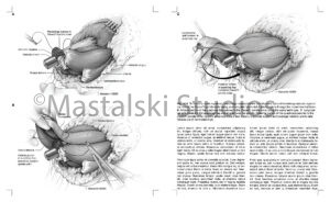 Journal Layout for Myodesis Creation