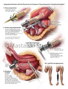 Summary of the novel steps of a revision surgery to prepare a transfemoral amputation for an osseointegrated prosthetic